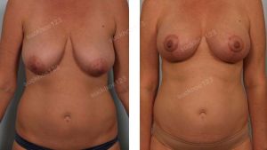 Treo ngực sa trễ kết hợp tiêm mỡ làm đầy cực trên vú, nữ 50 tuổi - ca 32