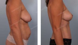 Combo treo ngực sa trễ không đặt túi & tạo hình thành bụng và hút mỡ, nữ 48 tuổi - ca 34