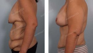 Combo treo sa trễ không đặt túi & tạo hình thành bụng & hút mỡ, nữ 40 tuổi sau giảm cân - ca 37
