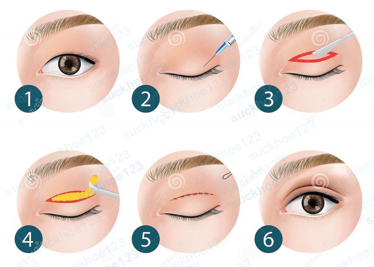 double eyelid surgery how to step vector illustration 167070123