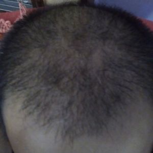 Tôi đã cấy 4000 cụm nang tóc từ 7 tháng trước nhưng tóc vẫn chưa mọc dày, có phải việc buộc khăn lên đầu sau phẫu thuật 20 ngày đã làm ảnh hưởng tới nang tóc?