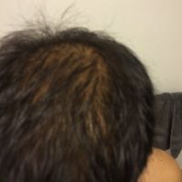 Rụng tóc hói do gen di truyền ở đỉnh đầu, tôi nên cấy tóc hay dùng minoxidil?