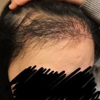 Cấy tóc thất bại, tôi nên làm gì để chỉnh sửa?