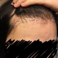 Cấy tóc thất bại, tôi nên làm gì để chỉnh sửa?