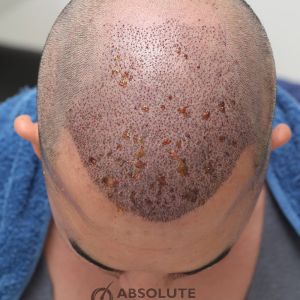 Cấy tóc FUE 3060 nang, nam 31 tuổi, kết quả sau 17 tháng - case 5