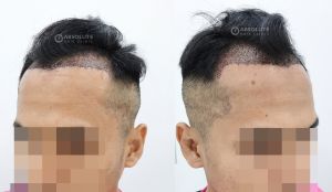 Cấy tóc FUE 2350 nang tóc điều trị hói chữ M, kết quả sau 7 tháng - case 85