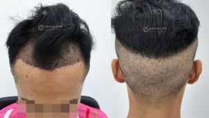 Cấy tóc FUE 2350 nang tóc điều trị hói chữ M, kết quả sau 7 tháng - case 85