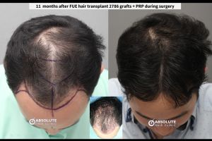 Cấy 2786 nang tóc, kỹ thuật FUE, kết quả sau 11 tháng - case 79