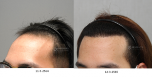 Cấy tóc FUE 2500 nang, kết quả sau 10 tháng - case 98