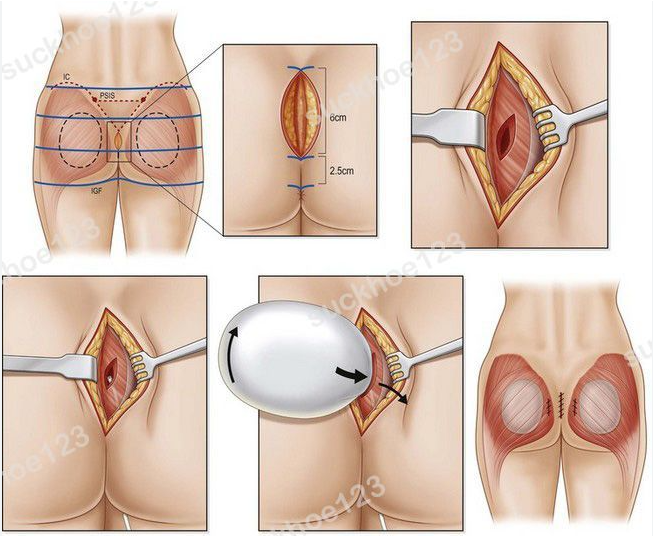 đường rạch và vết seo của phương pháp nâng mông