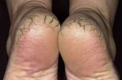 4 Cách xử trí khi da chân khô, nứt nẻ?