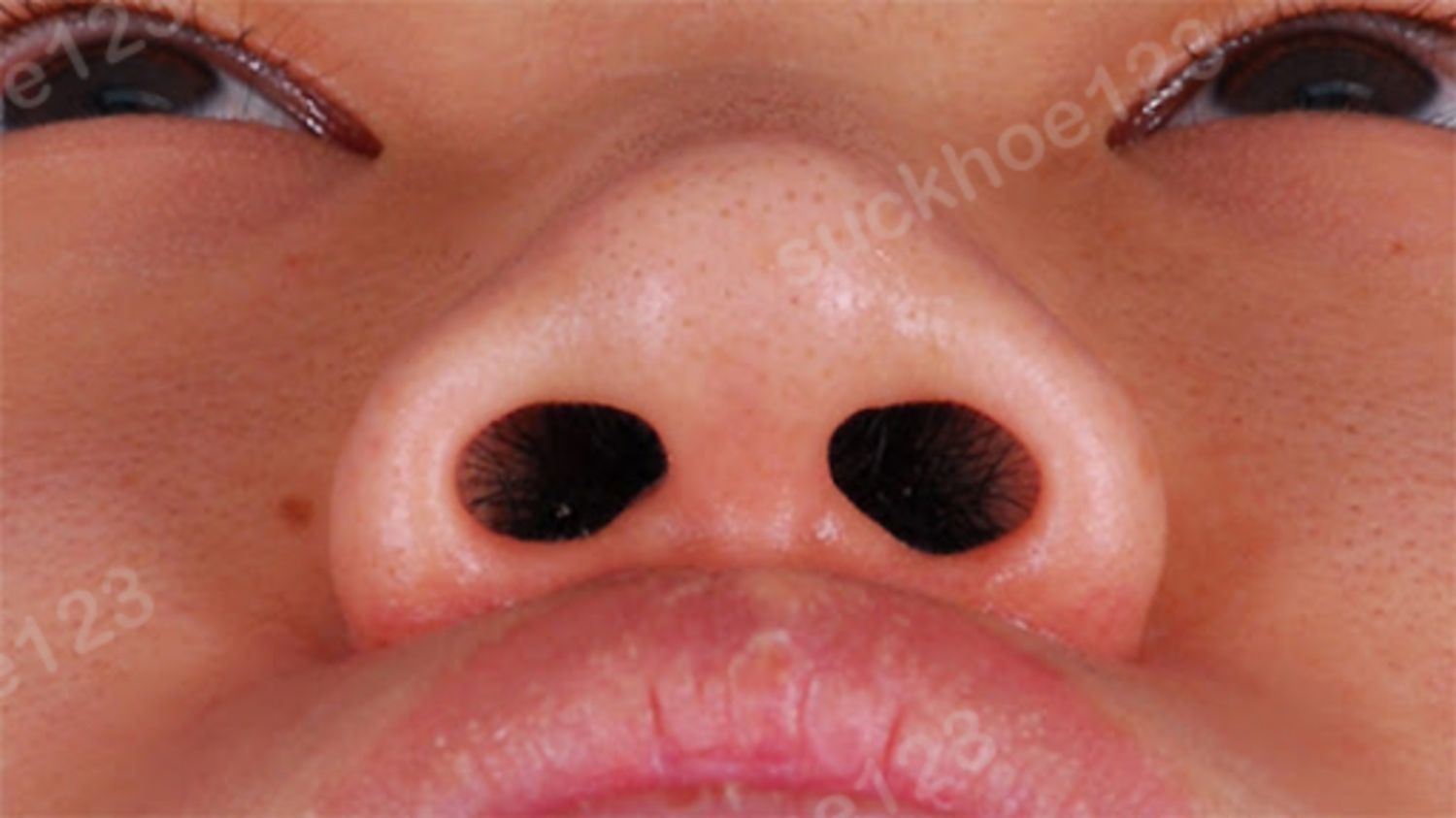 Các biến chứng có thể gặp phải sau phẫu thuật chỉnh hình, thu gọn cánh mũi
