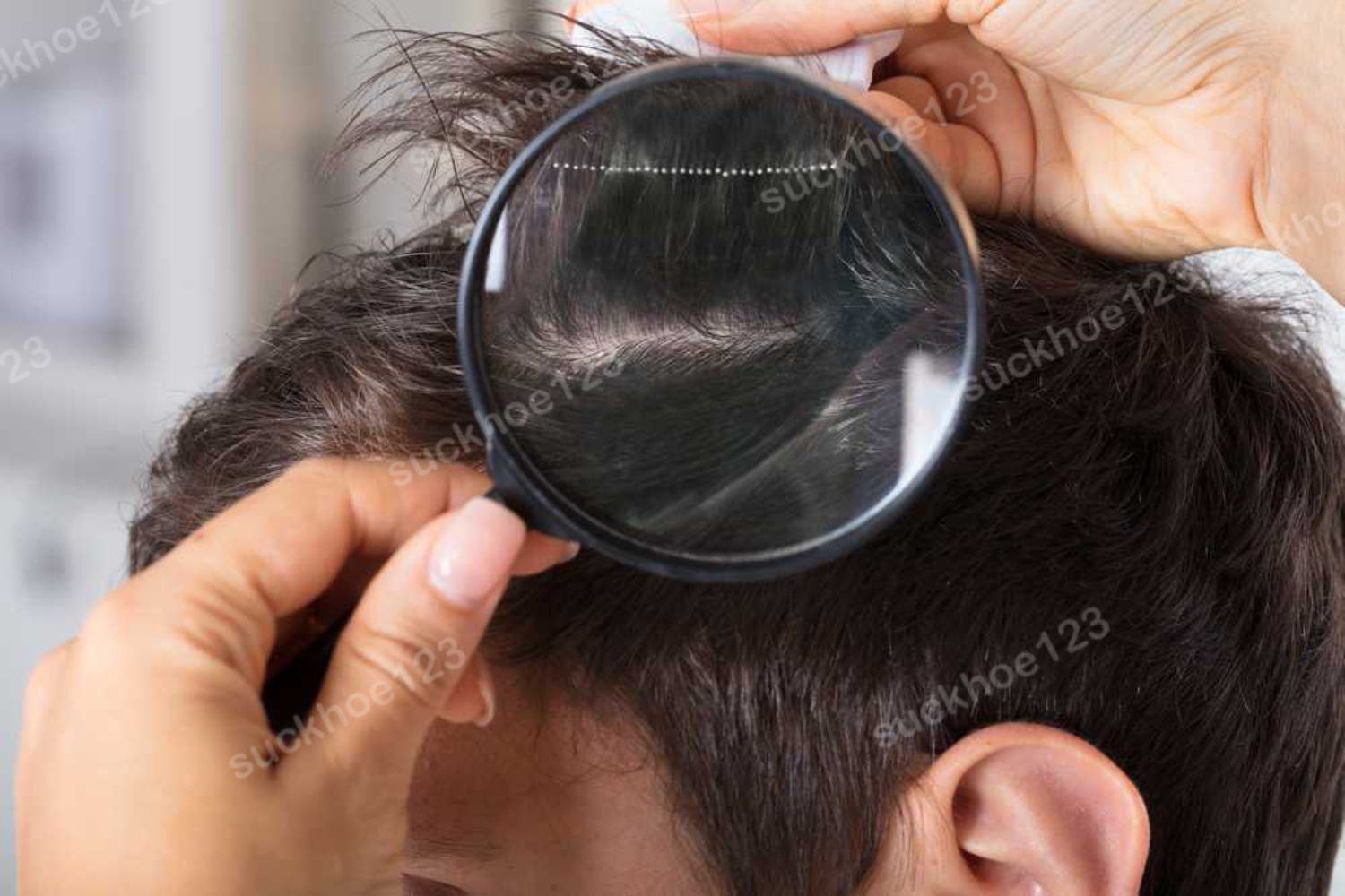 Chẩn đoán tình trạng rụng tóc