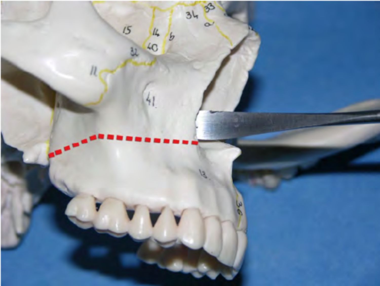 Phẫu thuật cắt xương hàm trên kiểu LeFort 1
