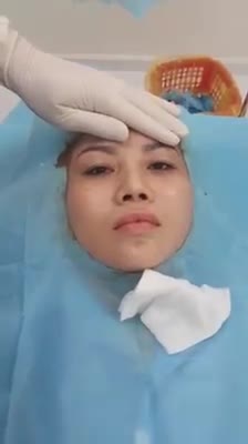 Cắt mí mắt Miniplasty - Bs Trần Phương