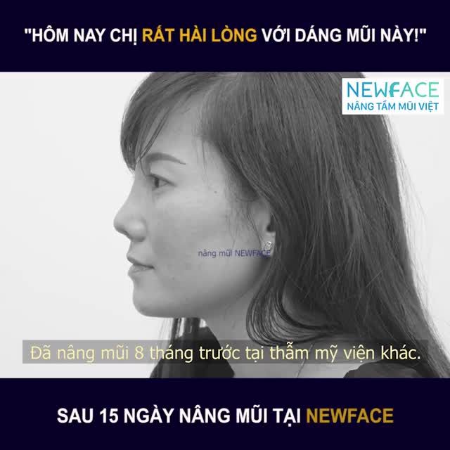 KH Ánh Dung đến tái khám sau nâng mũi 15 ngày tại Newface