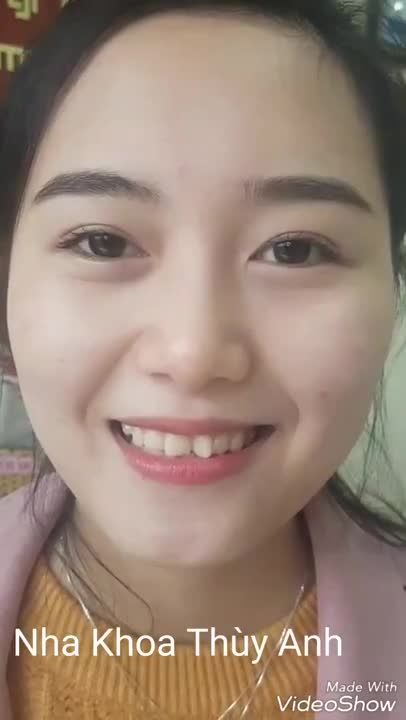 Răng sứ thẩm mỹ tốt nhất Thái Nguyên - Bạn gái cực xinh sau khi sửa răng