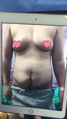 Kết quả mỹ mãn sau phẫu thuật tạo hình thành bụng chuyển rốn - Dr Quang Đức 108 - ca 1