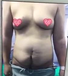 Kết quả mỹ mãn sau phẫu thuật tạo hình thành bụng chuyển rốn - Dr Quang Đức 108 - ca 1