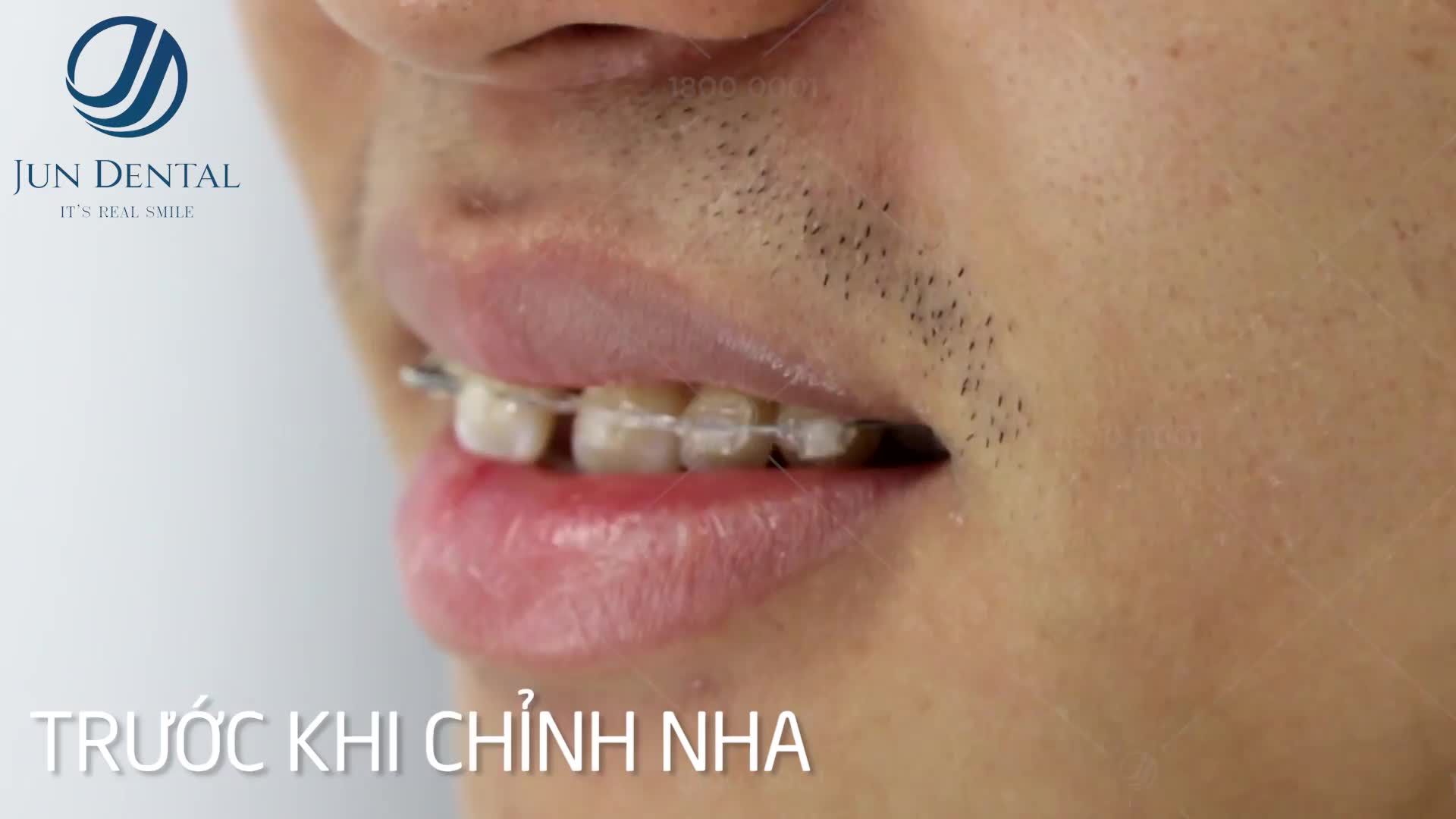 Tiến triển sau 05 tháng thực hiện niềng răng của bạn Trần Văn Thiên - 24 tuổi tại Jun Dental.