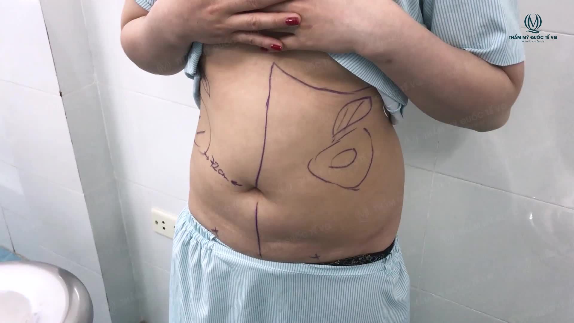 Hút mỡ vùng thừa kết hợp cấy mỡ ngực với công nghệ " BODY JET "