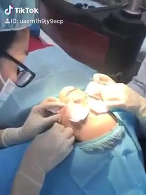 Cận cảnh quá trình điều trị sẹo lõm, sẹo rỗ bằng phương pháp BioScar tại bệnh viện thẩm mỹ Đông Á
