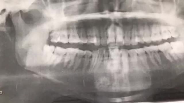 Nhổ răng R18 sâu vỡ lớn thân răng