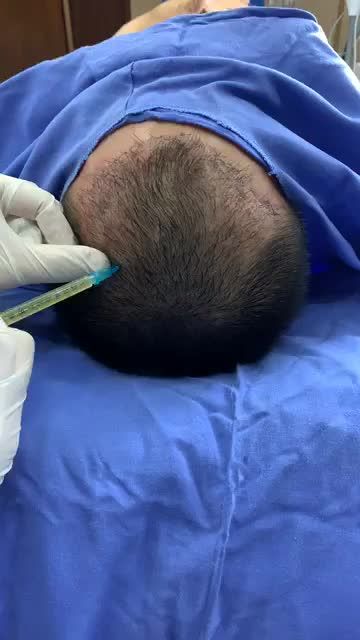 Quy trình điều trị rụng tóc bằng công nghệ HAIRFULL BVTM Kangnam Hà Nội