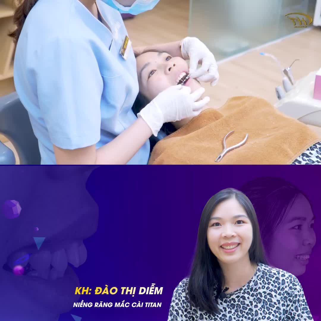 Chia sẻ của khách hàng tháo niềng sau khi hoàn thành phác đồ niềng răng tại Nha khoa - Dr Hoàng Tuấn