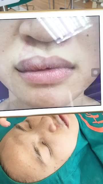 Ngắm môi xinh “chúm chím” một chút với kết quả phẫu thuật tạo hình môi của bác sĩ nhé!