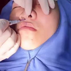 Phẫu thuật sửa sẹo môi cho khách hàng bị sứt môi hở hàm ếch - dự kiến kết quả đạt 90% sau phẫu thuật