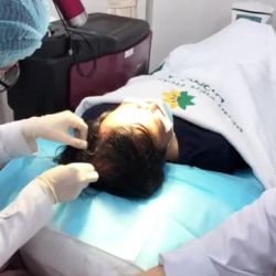 Quá trình tiêm Biohair điều trị rụng tóc cho khách Tại bệnh viện thẩm Mỹ Đông Á
