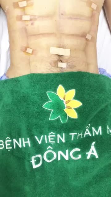Siết cơ bụng 6 múi chỉ sau 2 ngày Các bạn không tin có thể đến ngay viện thẩm Mỹ Đông Á Sài Gòn