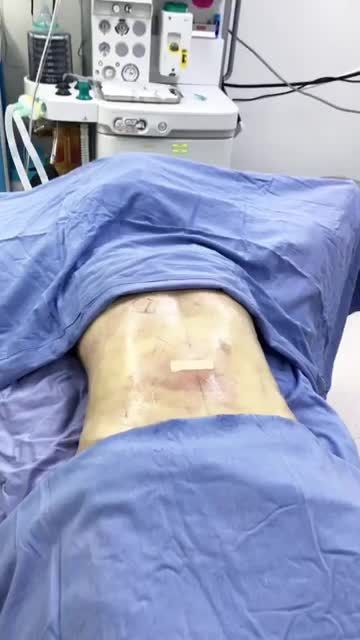 Kết Quả Lipo toàn thể, trên dưới, và 2 eo  tại bệnh viện Thẫm Mỹ Đông Á