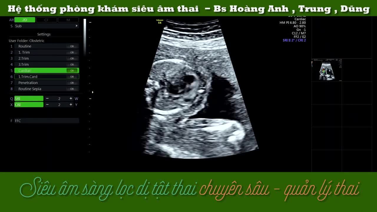 Tim thai 18 tuần 6 ngày, hệ thống PK sàng lọc dị tật thai chuyên sâu Bs Anh, Trung, Dũng