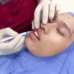 Bác sĩ Kangnam phân tích phẫu thuật thu mỏng môi cho khách hàng nam sở hữu đôi môi dày