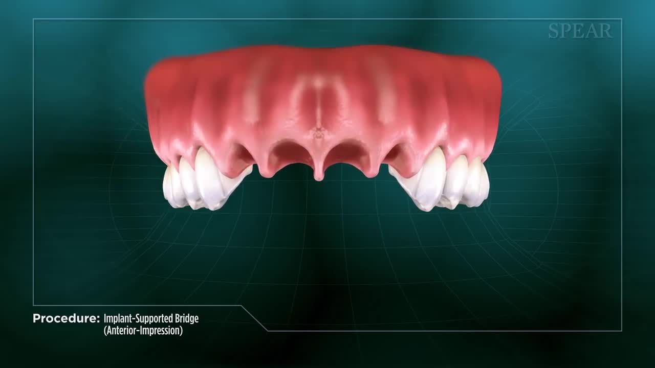 Phục hình cầu răng sứ trên Implant - Giải pháp tối ưu cho trường hợp mất nhiều răng liền kề