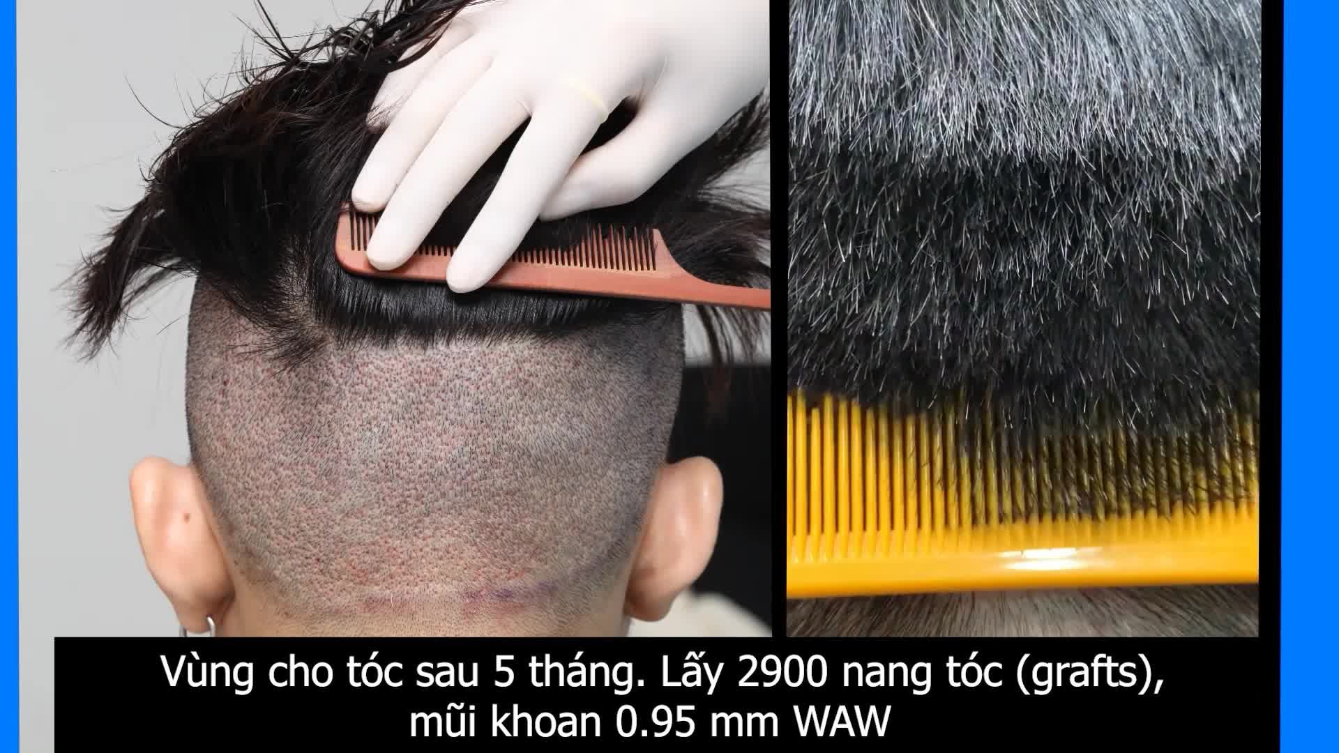 Vùng cho tóc sau khi lấy 2900 nang tóc sẽ như thế nào?