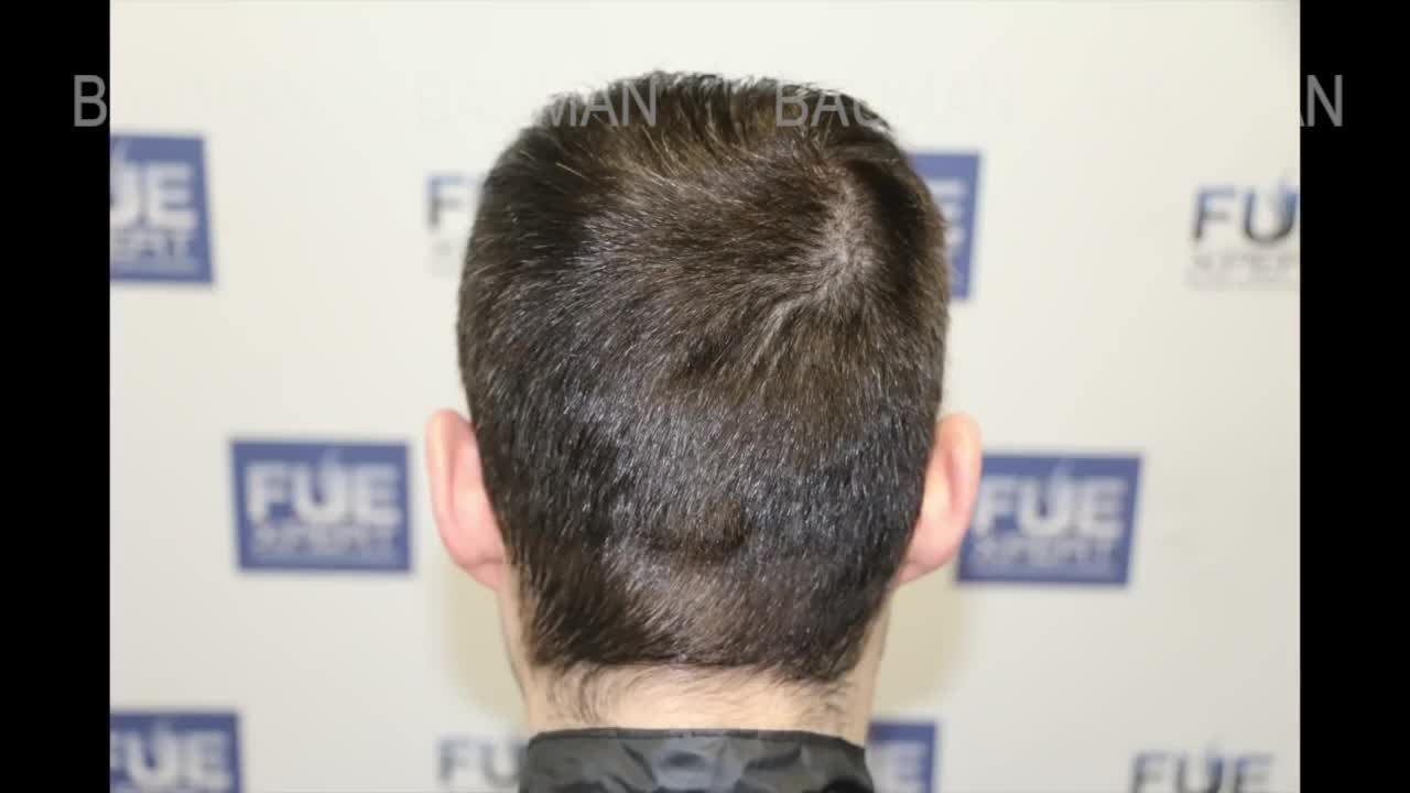 Cấy tóc FUE (3467 + 1000 nang tóc), khắc phục hói đầu mức độ 4A