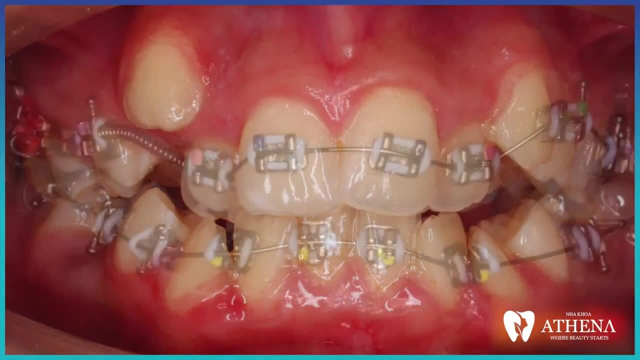 Cận cảnh thay đổi răng khấp khểnh bằng phương pháp Niềng Răng