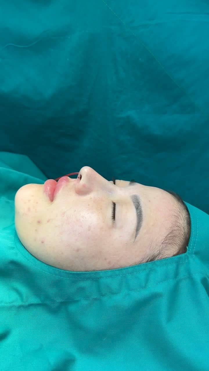 Khắc phục sống mũi thấp tẹt, có gồ nhẹ, da mũi mỏng cho bạn gái đến từ Quận 5 - TP HCM.