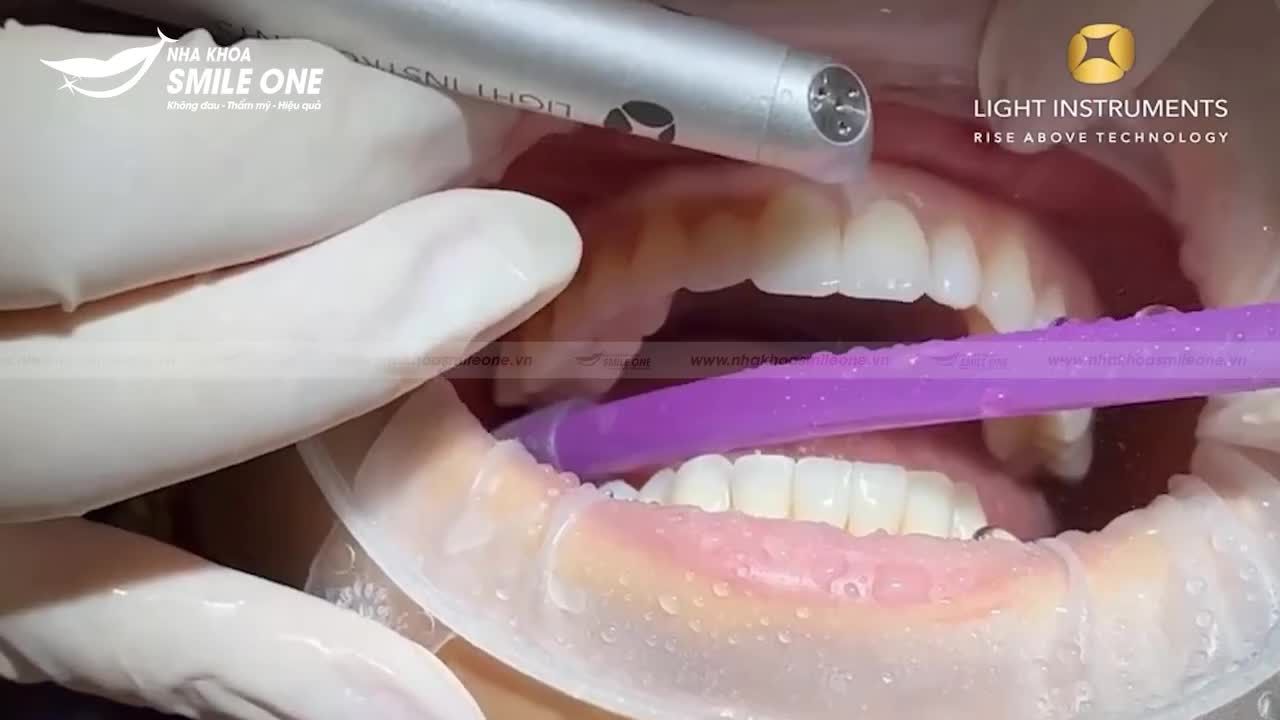 Xem thêm 7 video Mặt Dán Sứ Veneer của bác sĩ Bs nha khoa Smile One