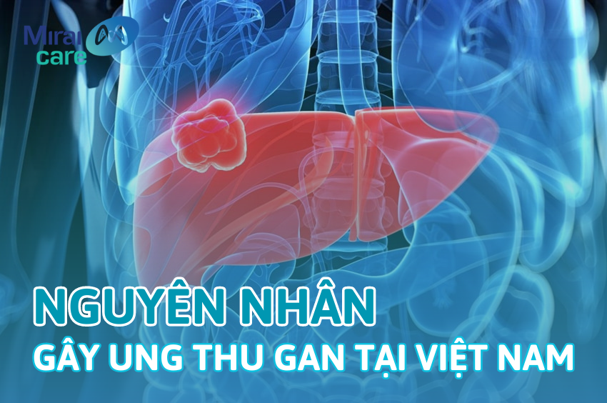 Vạch trần 11 nguyên nhân gây ung thư gan cho người Việt Nam