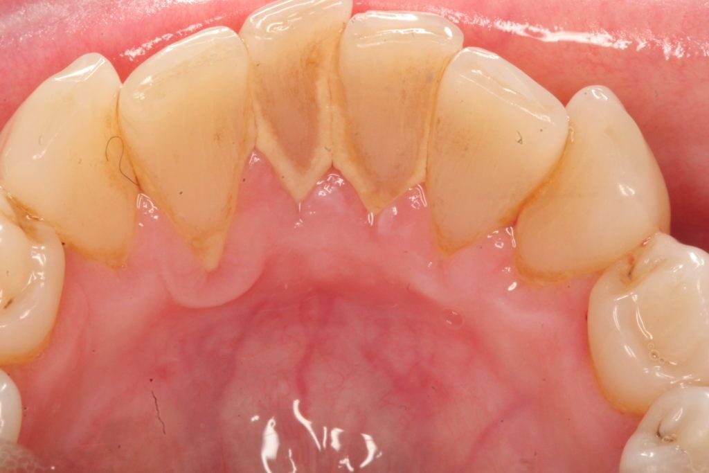 Cao răng là gì? 6 típ để hạn chế cao răng