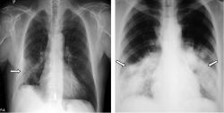 Đặc điểm tổn thương phổi do COVID-19 trên hình ảnh X-quang và cắt lớp vi tính - Bệnh viện 108