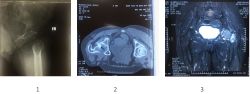 Thay khớp háng cho trường hợp tiêu cổ chỏm xương đùi do u tương bào: bài học kinh nghiệm - Bệnh viện 108
