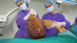Giải cứu nữ bệnh nhân mang khối u khổng lồ 10 kg hơn 39 năm - Bệnh viện Việt Đức