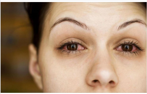 Biến chứng nguy hiểm trên mắt ở bệnh nhân Covid-19