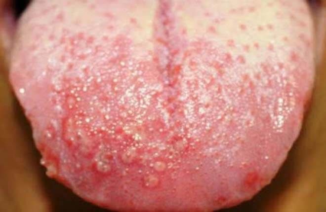 herpes luoi
