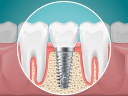 Người bị loãng xương có thể trồng răng implant không?